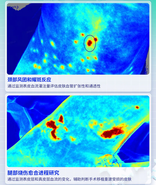 瑞沃德激光散斑血流成像系統獲批FDA認證